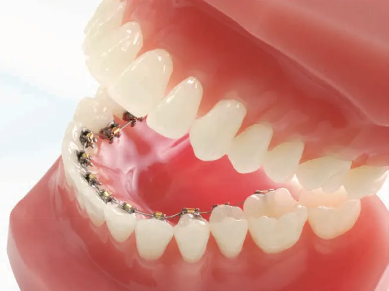 ワイヤー矯正裏側